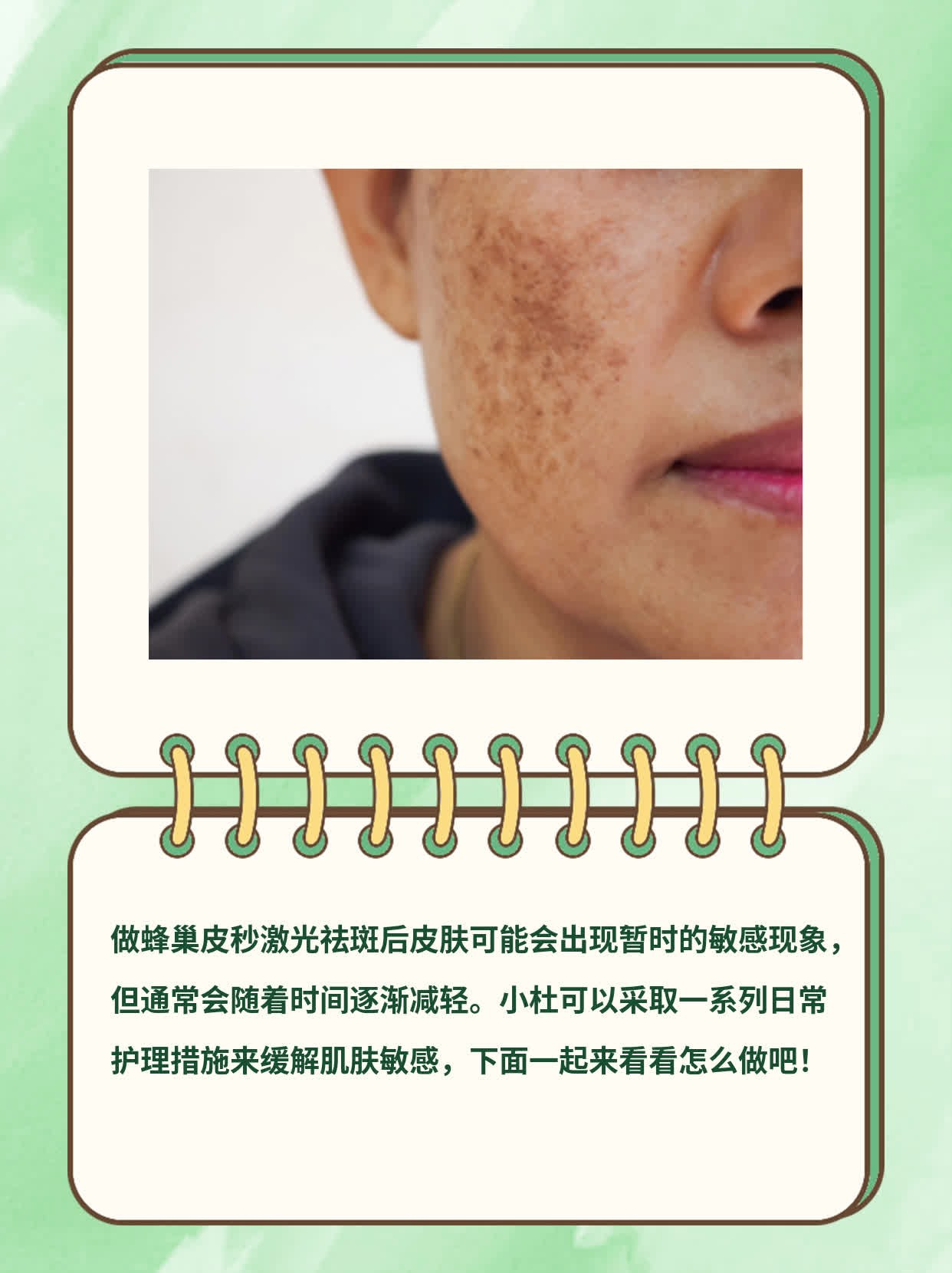 揭秘蜂巢皮秒激光祛斑后的肌肤敏感度！