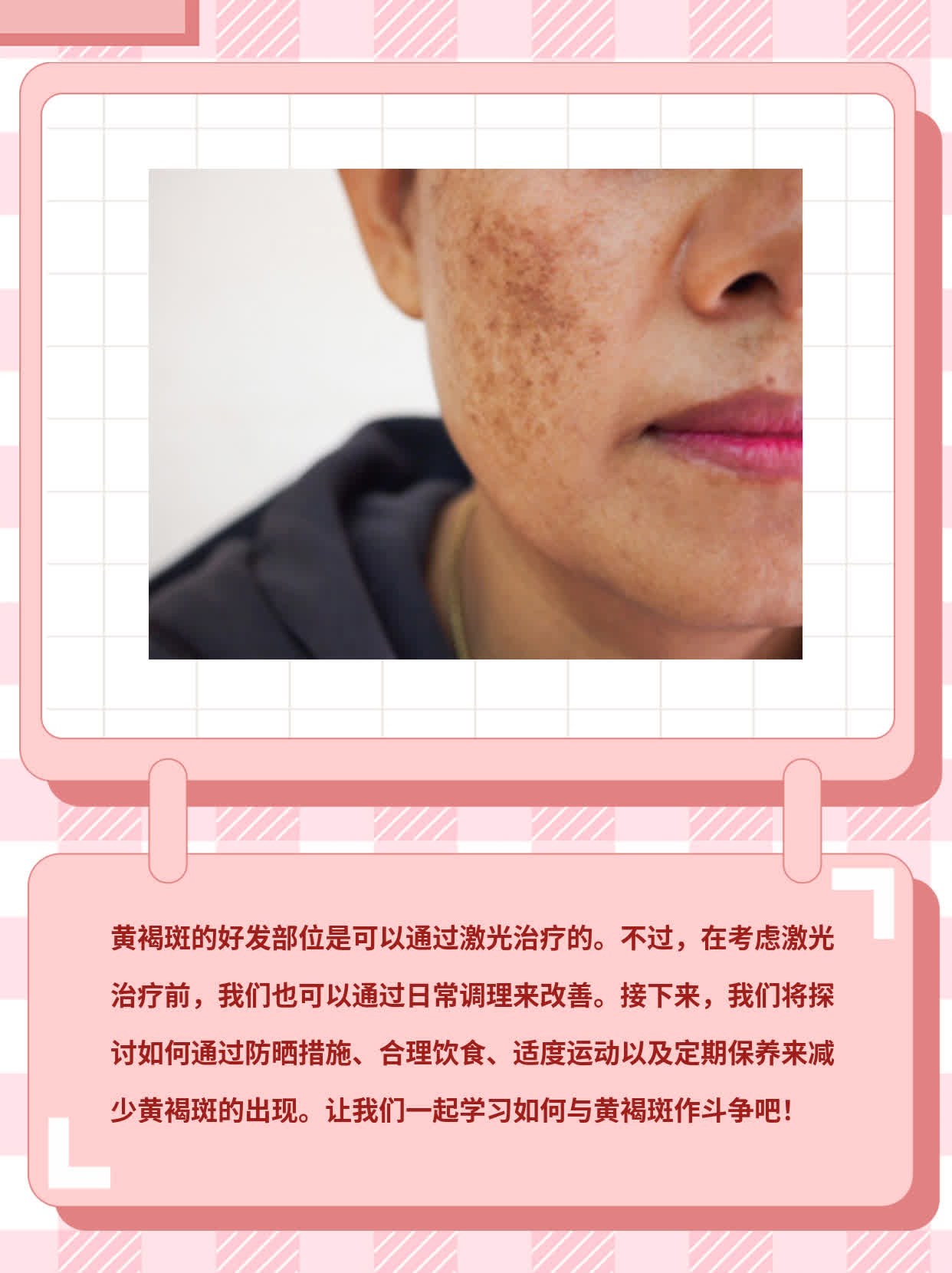 黄褐斑好发部位可否激光？经验分享