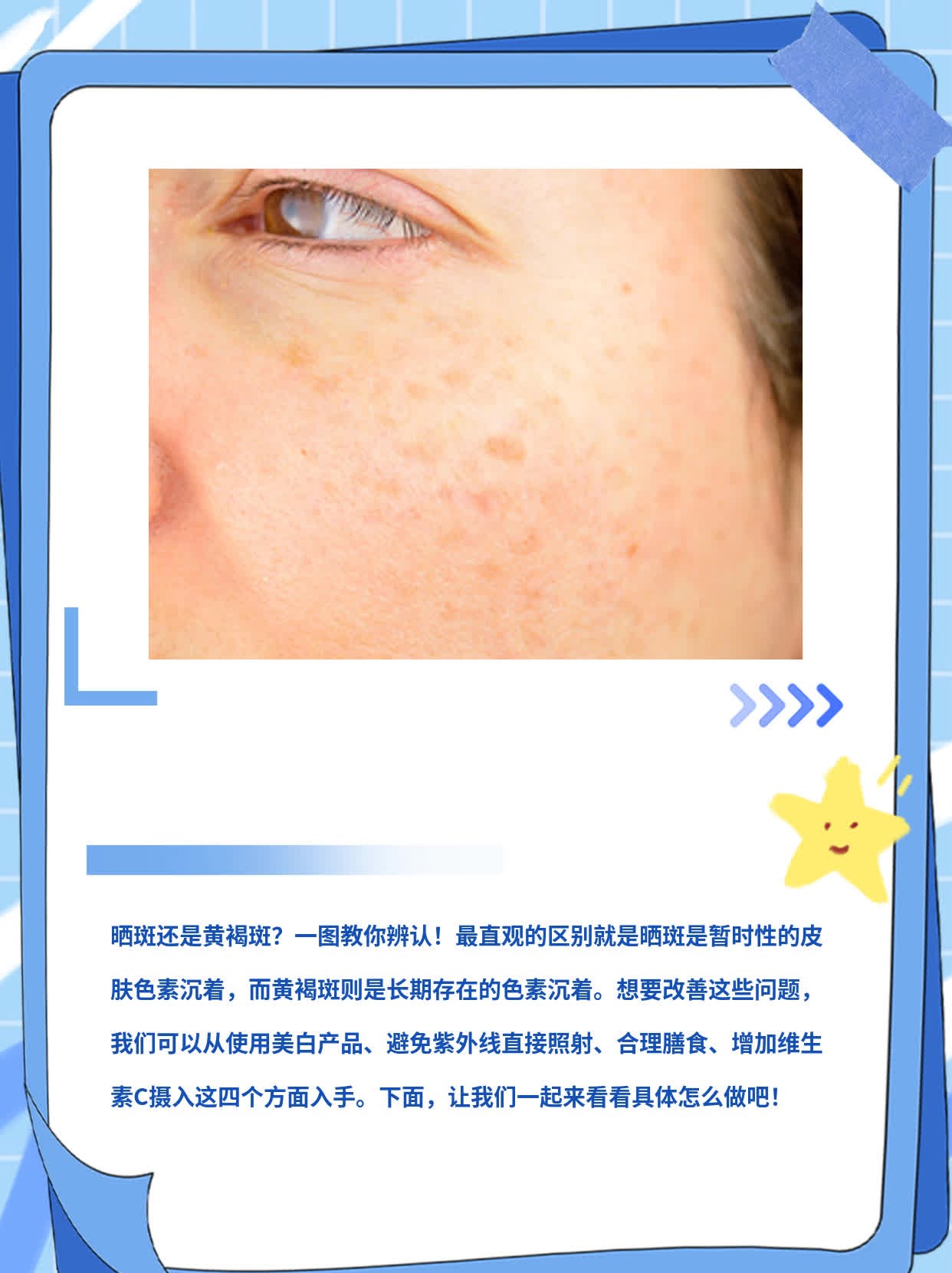 晒斑还是黄褐斑？一图教你辨认！