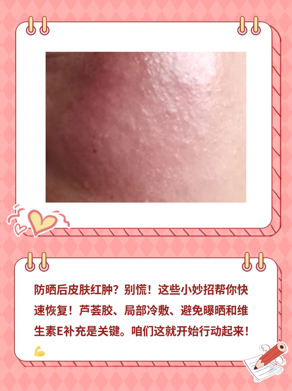晒伤后快速修复法：应对太阳带来的肌肤红肿