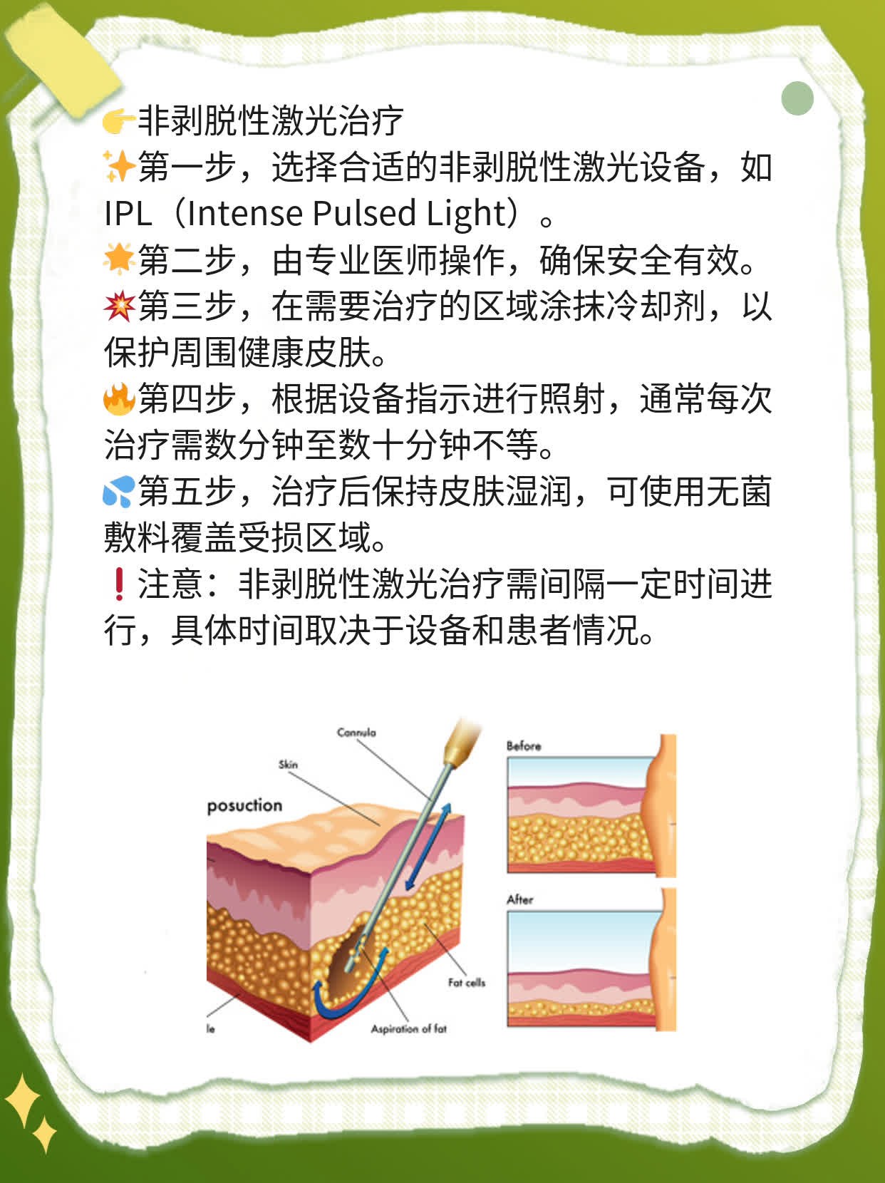 「揭秘」激光祛疤技术大揭密：X次治疗搞定难缠痘疤！