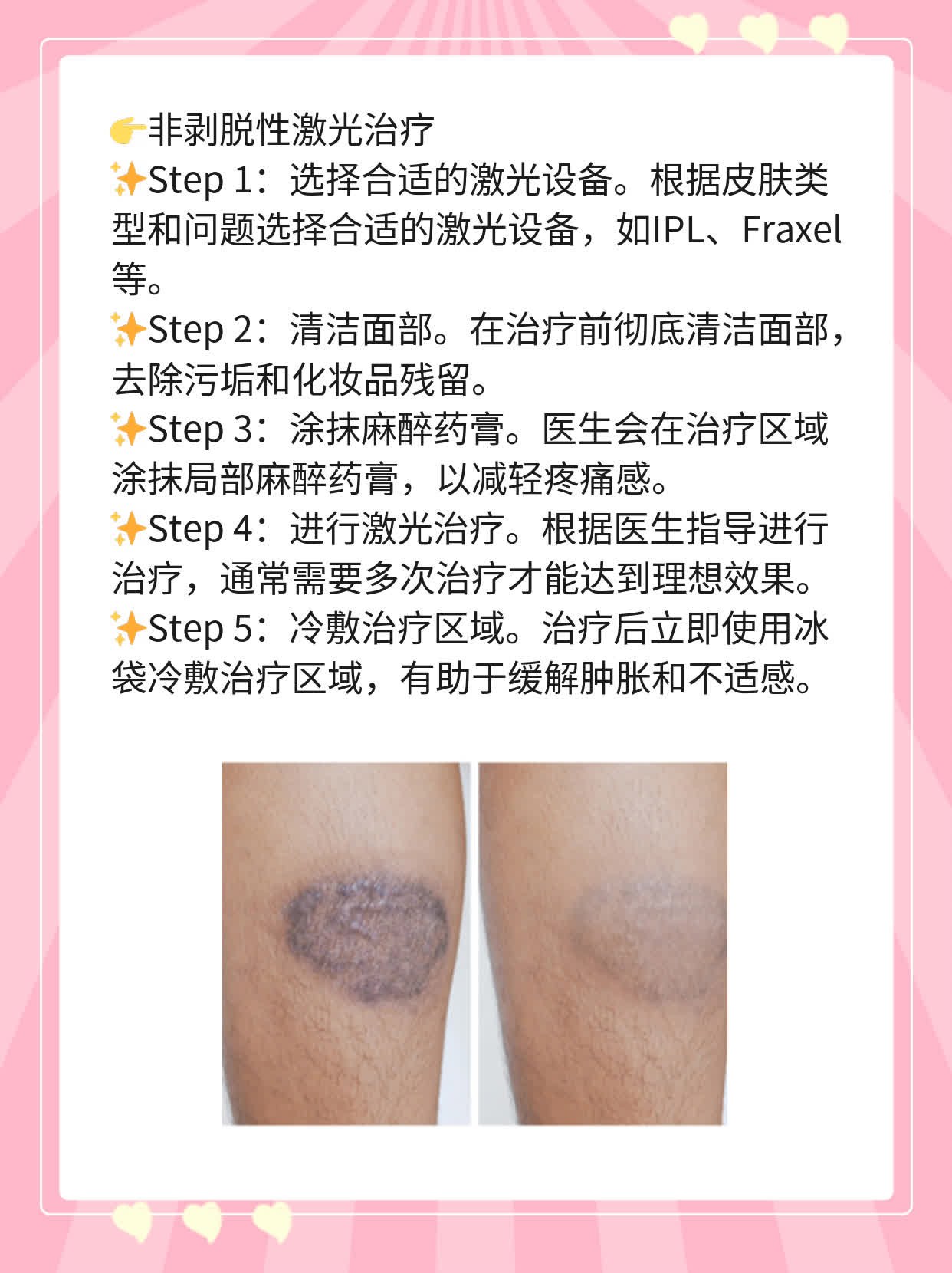 激光去痘印痘坑效果揭秘！