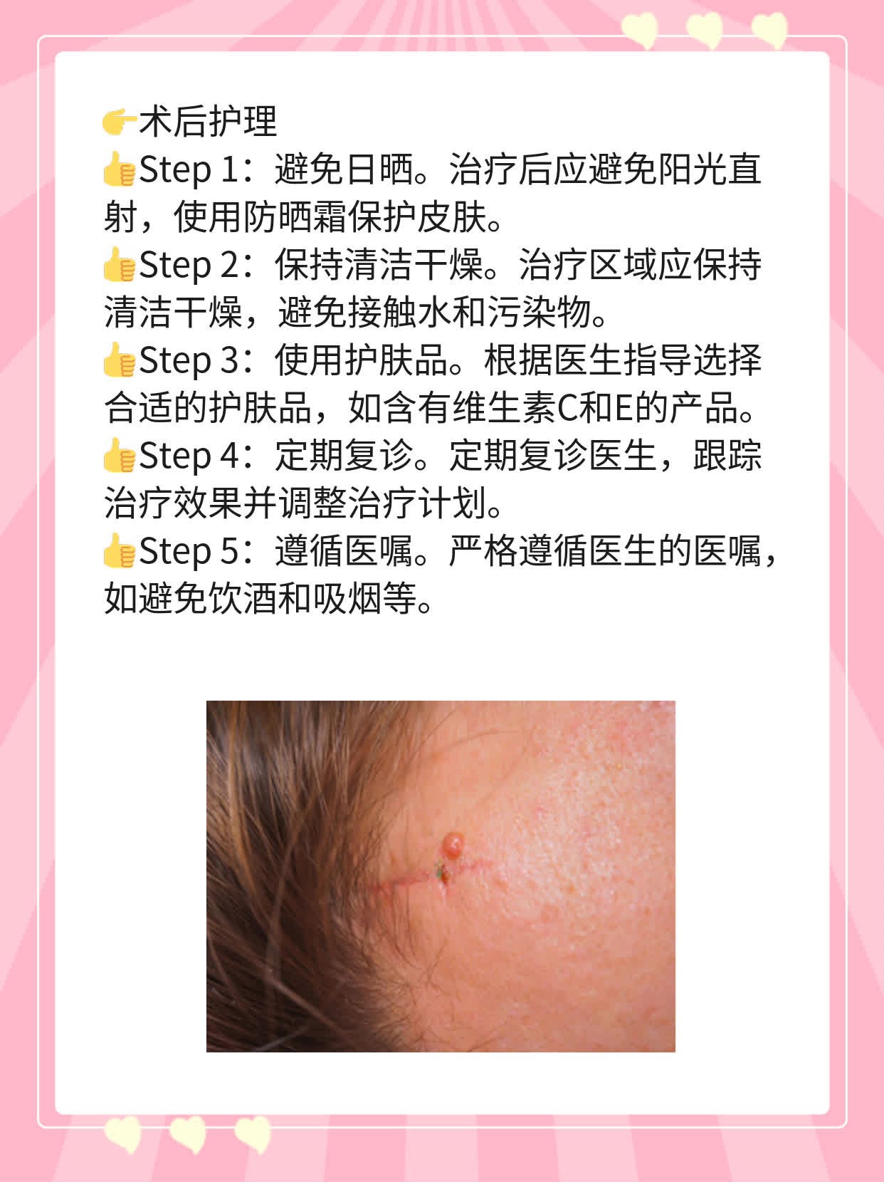 激光去痘印痘坑效果揭秘！