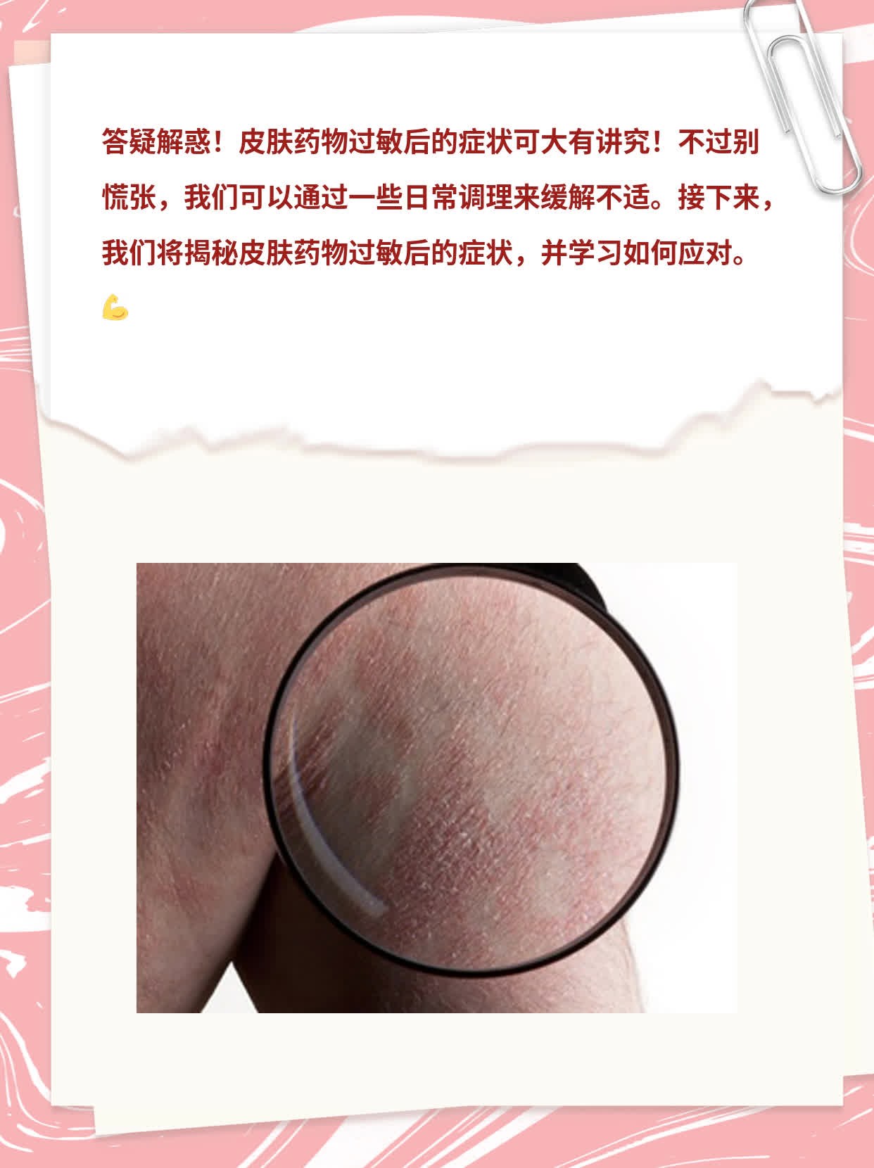 揭秘：皮肤药物过敏后的症状大曝光！