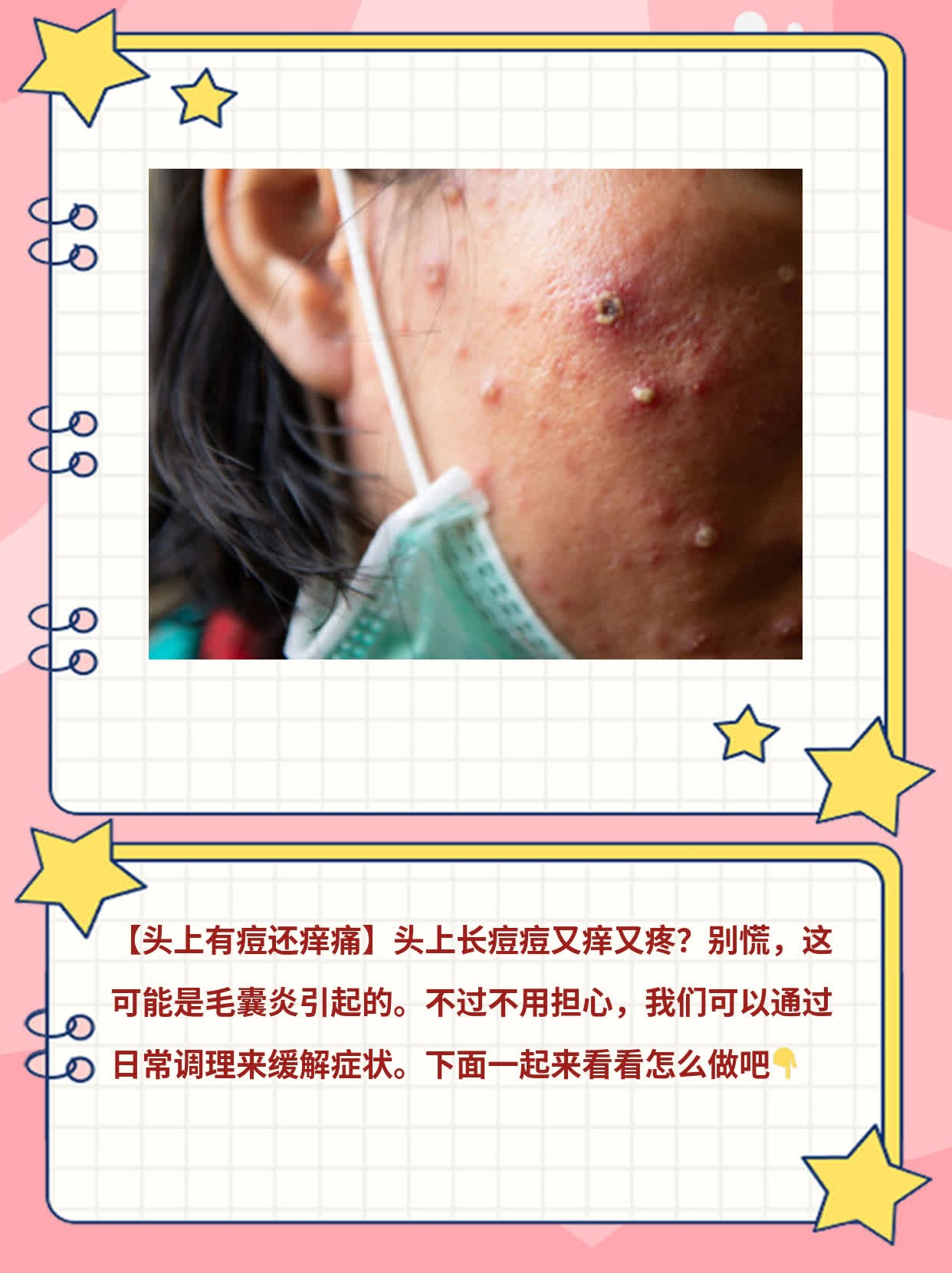 「头上有痘还痒痛」原因揭秘！