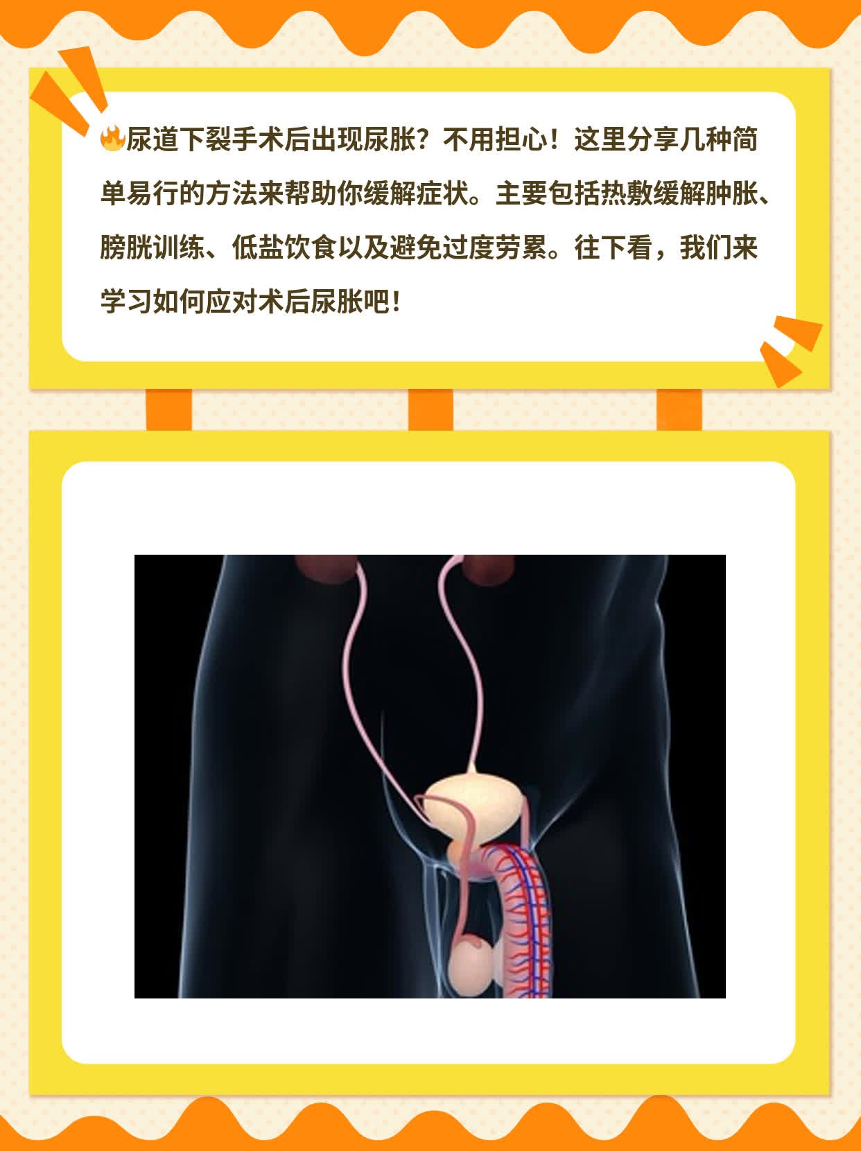 术后尿胀处理法：尿道下裂手术后遗症妙招