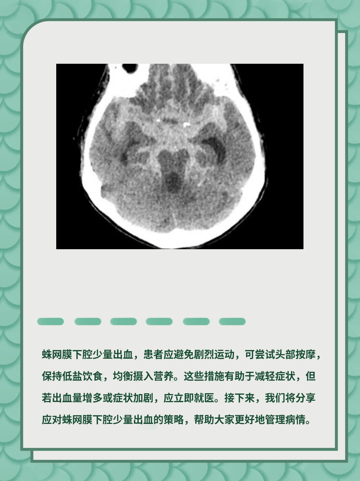 蛛网膜下腔少量出血：应对策略分享