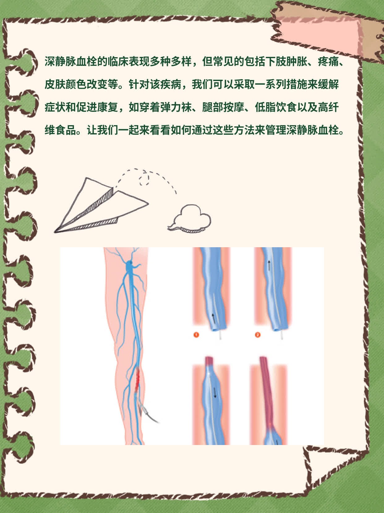 【经验分享】深静脉血栓：临床表现&治疗方案大揭秘！