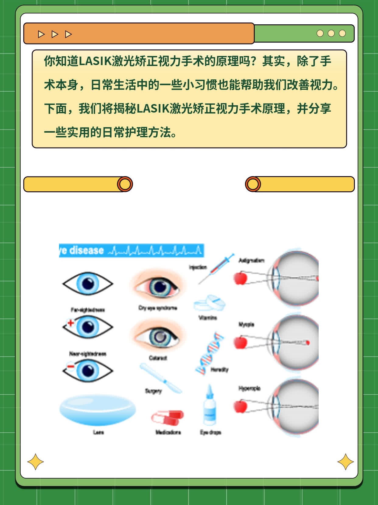 揭秘LASIK激光矫正视力手术原理