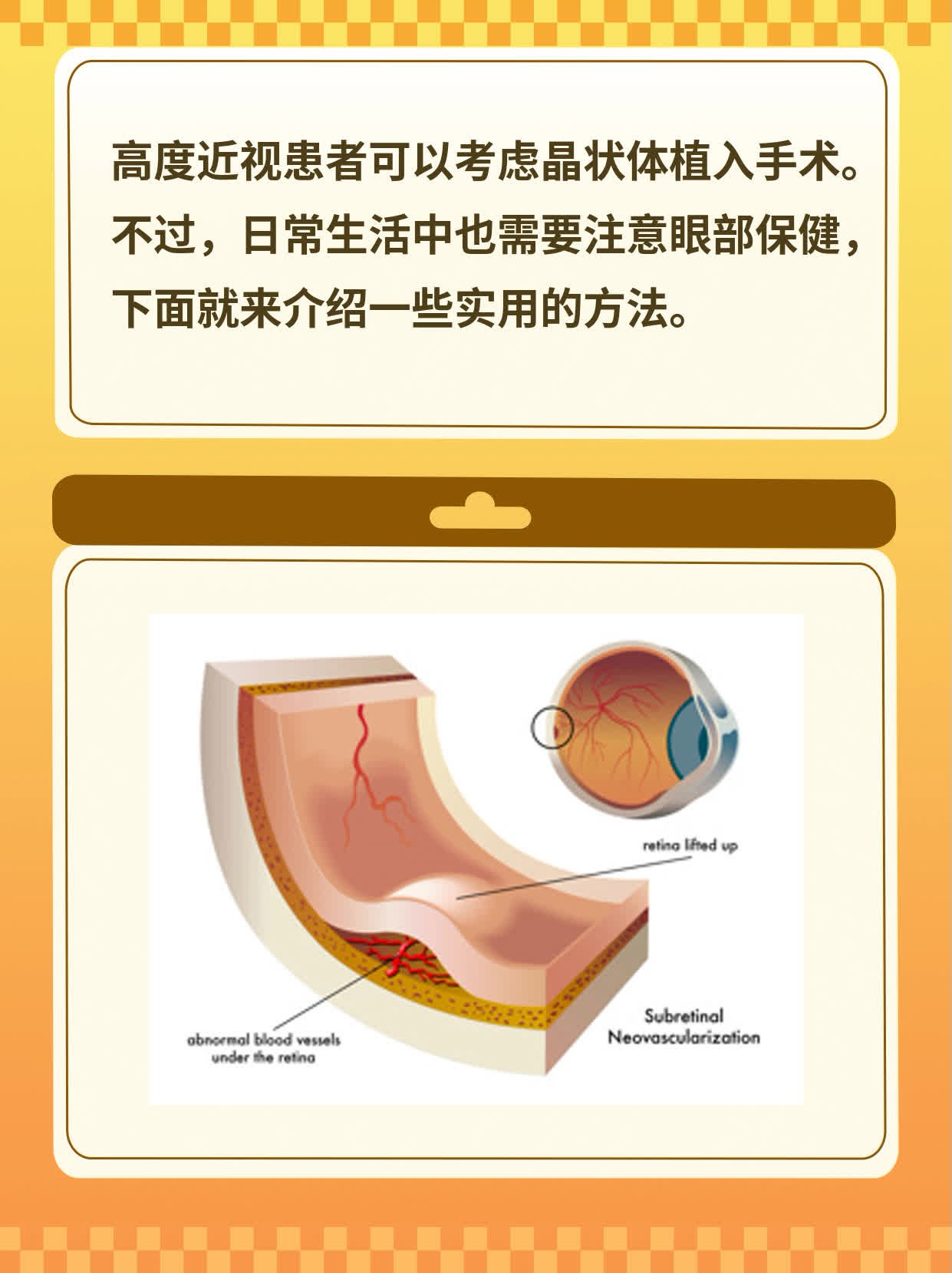 「近视矫正」：探讨高度近视晶状体植入术可行性