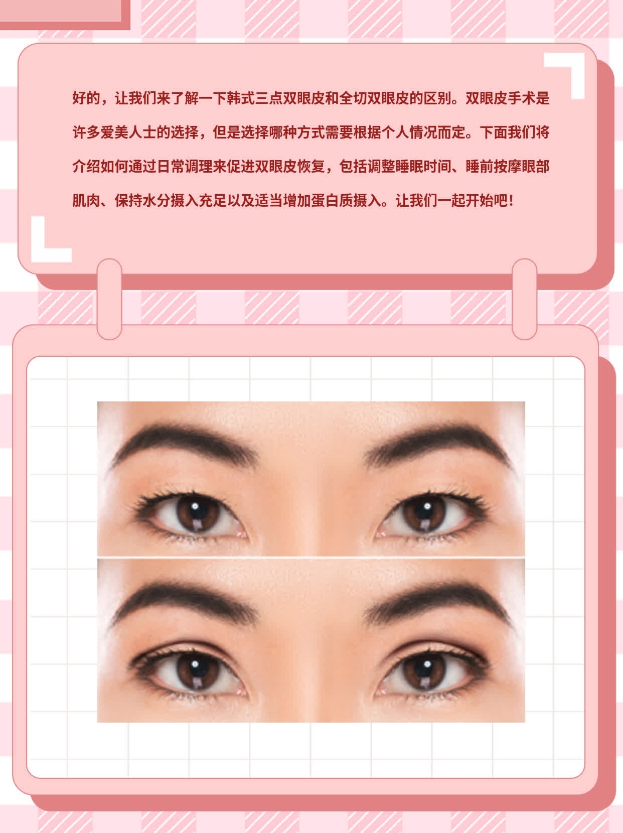 「双眼皮科普」：区别全切&三点——韩式重睑术