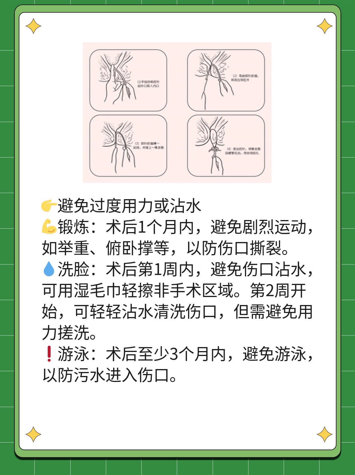 「双眼皮」迷思：扇形or平行？