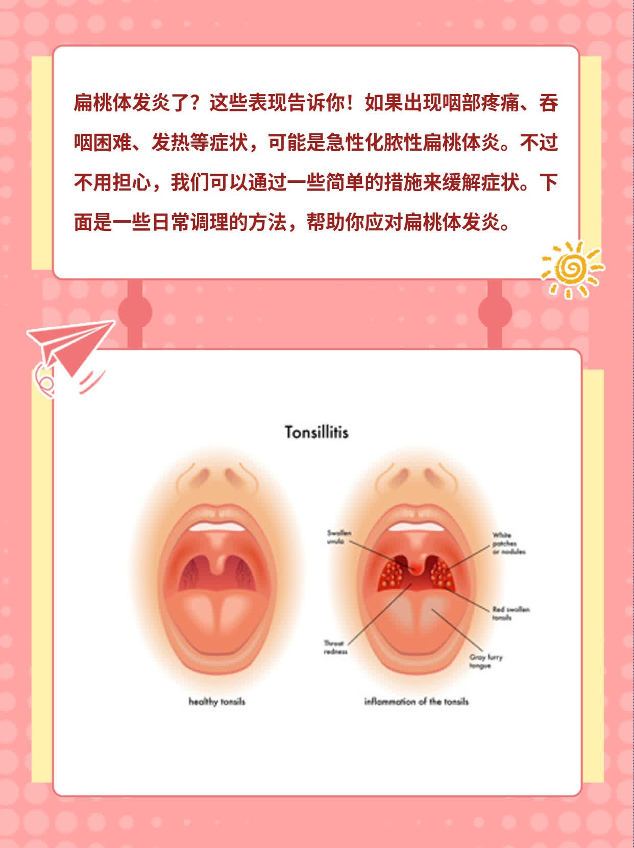 急性化脓性扁桃体炎的表现有哪些