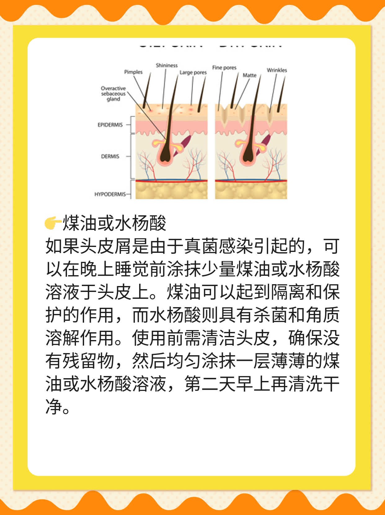 「头皮屑烦恼」：如何摆脱恼人小碎屑？