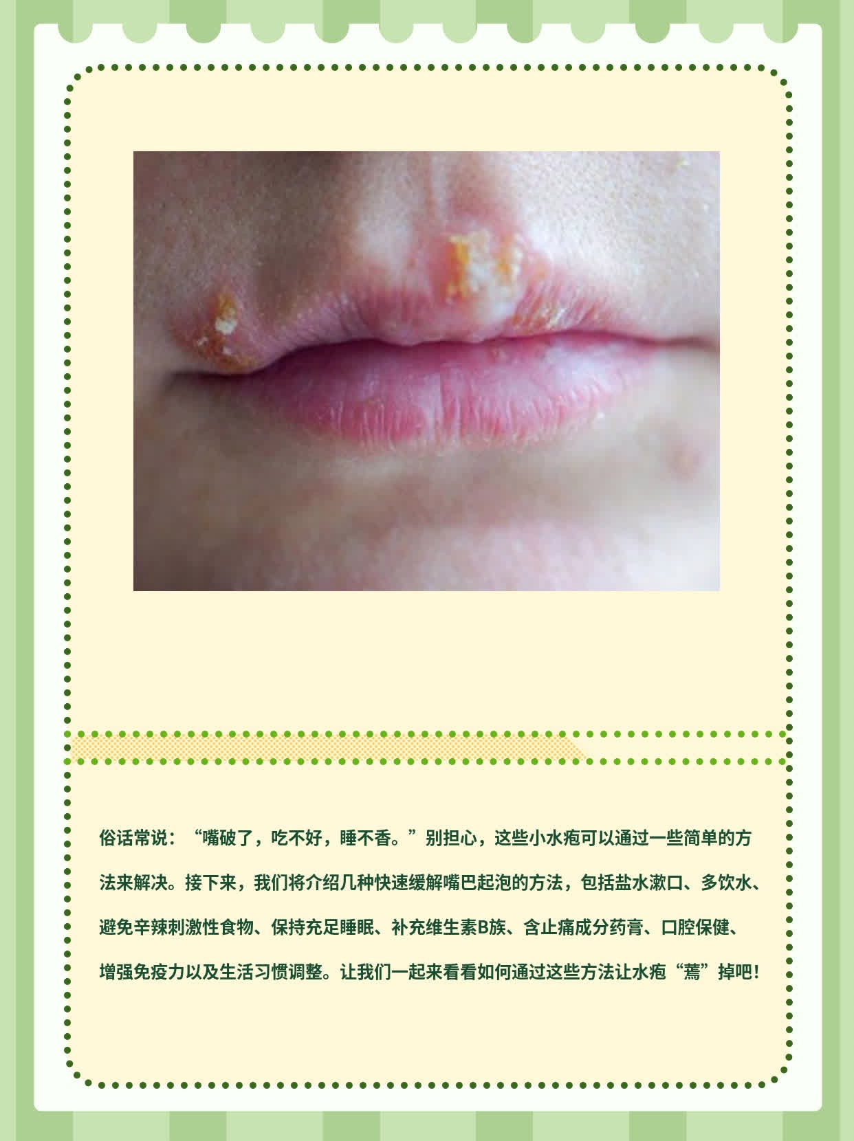 嘴巴起泡？这些招式让水疱“蔫”掉！