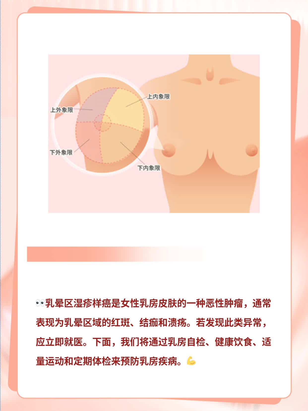揭秘乳晕区湿疹样癌：女性乳房皮肤变化图解