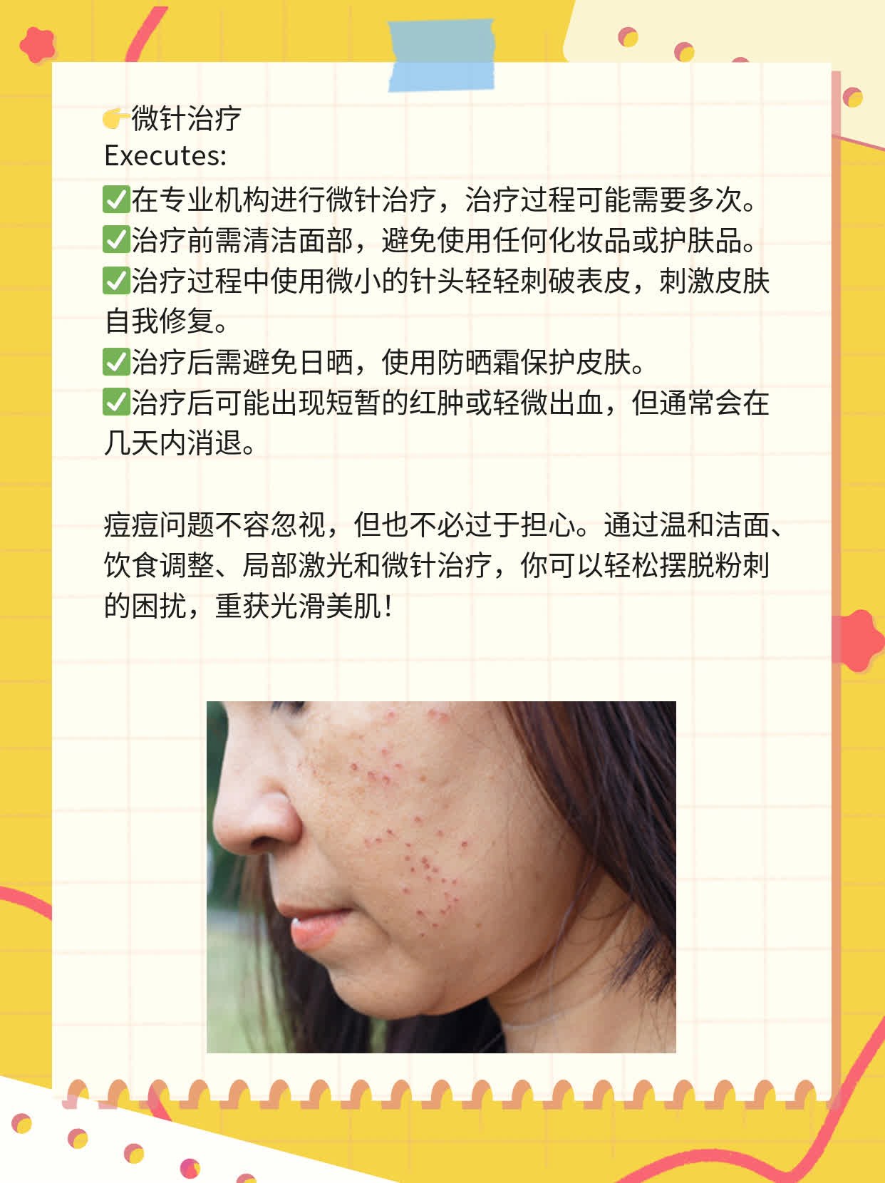 「祛痘攻略」揭秘多种方法告别粉刺