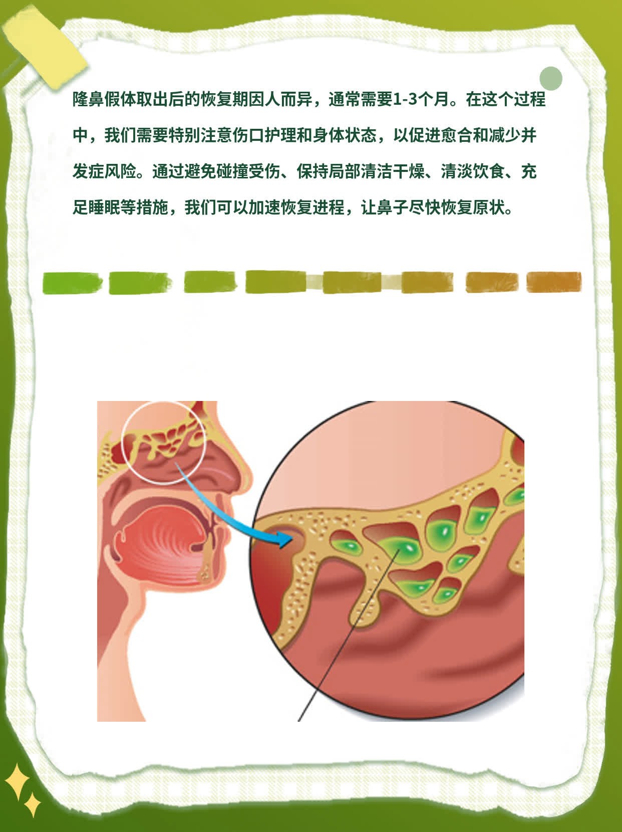 隆鼻假体取出后的恢复期探秘