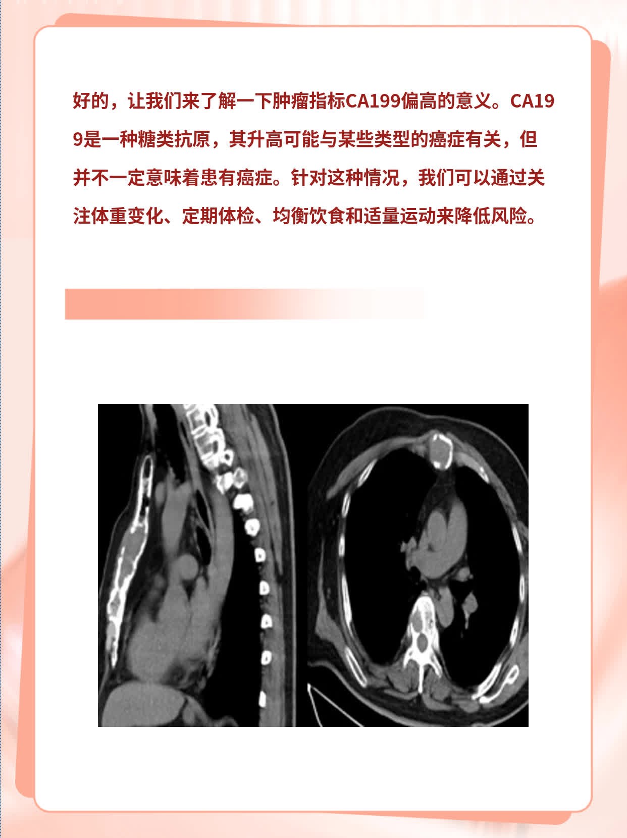 CA199偏高意味着什么？肿瘤指标解析