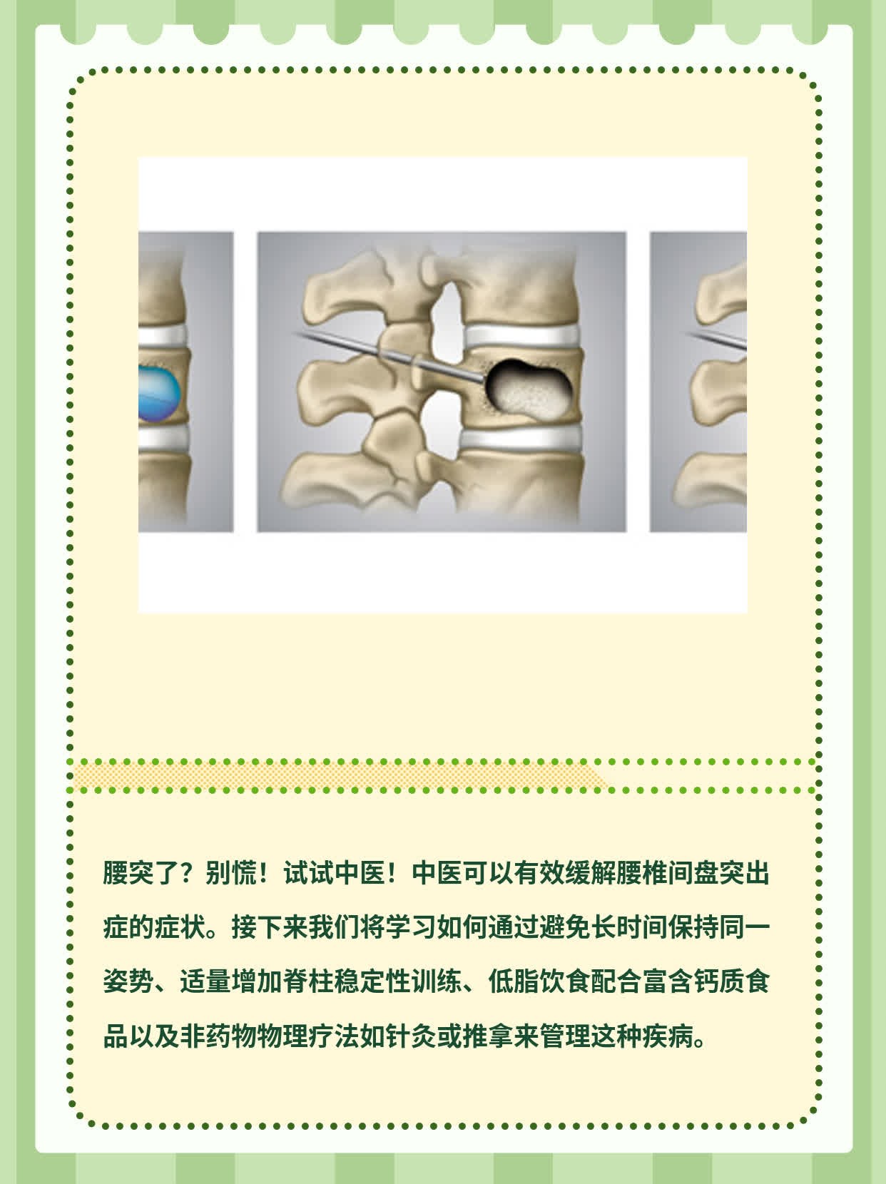 「腰突了？别慌！试试中医！」——腰椎间盘突出症的中医治疗指南