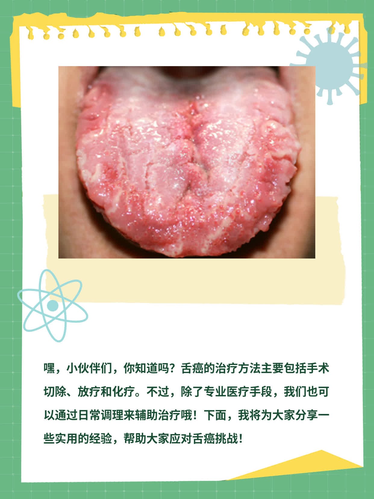 「经验分享」舌癌治疗方案大揭秘！