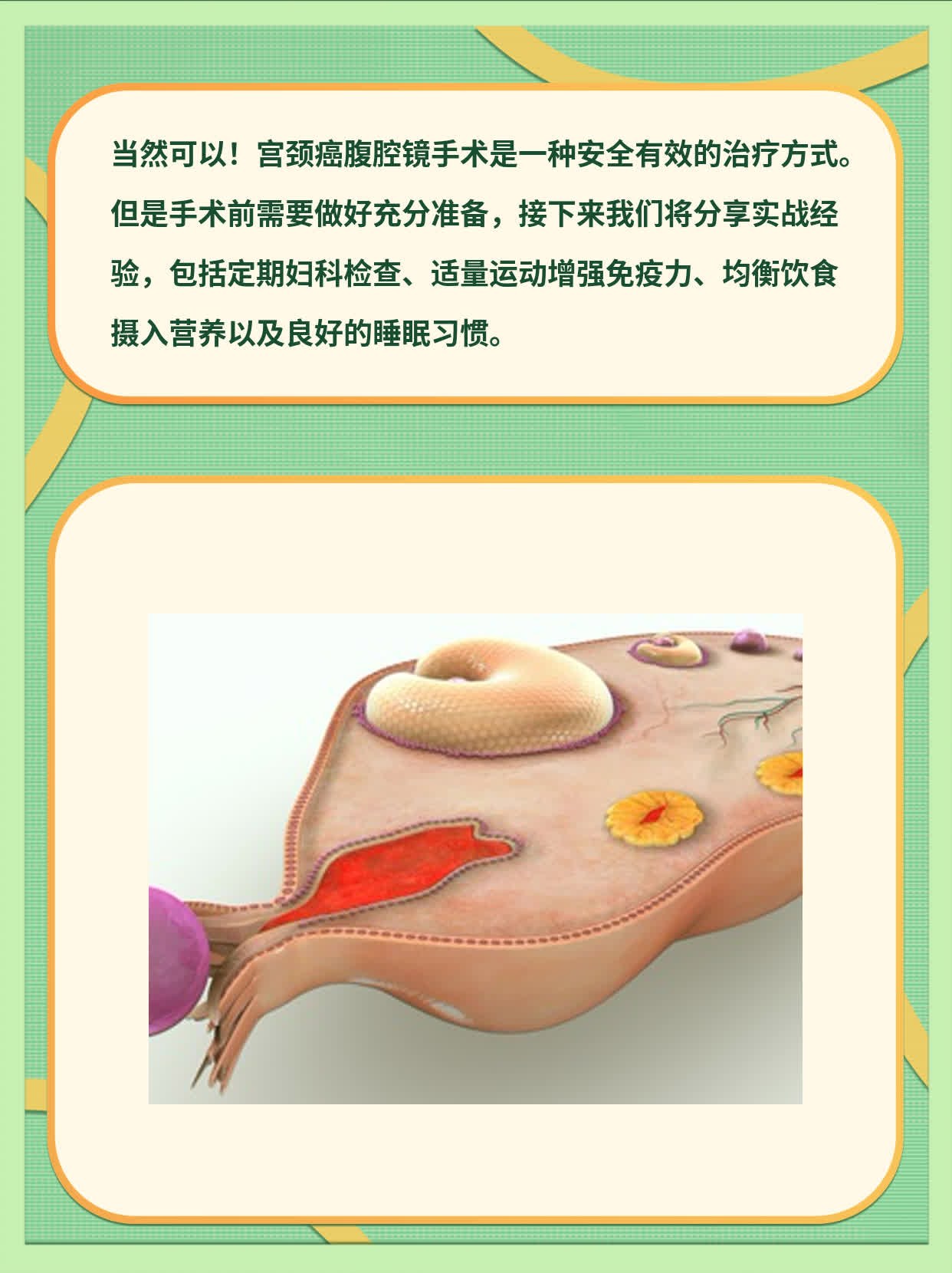 「宫颈癌腹腔镜手术」实战经验分享