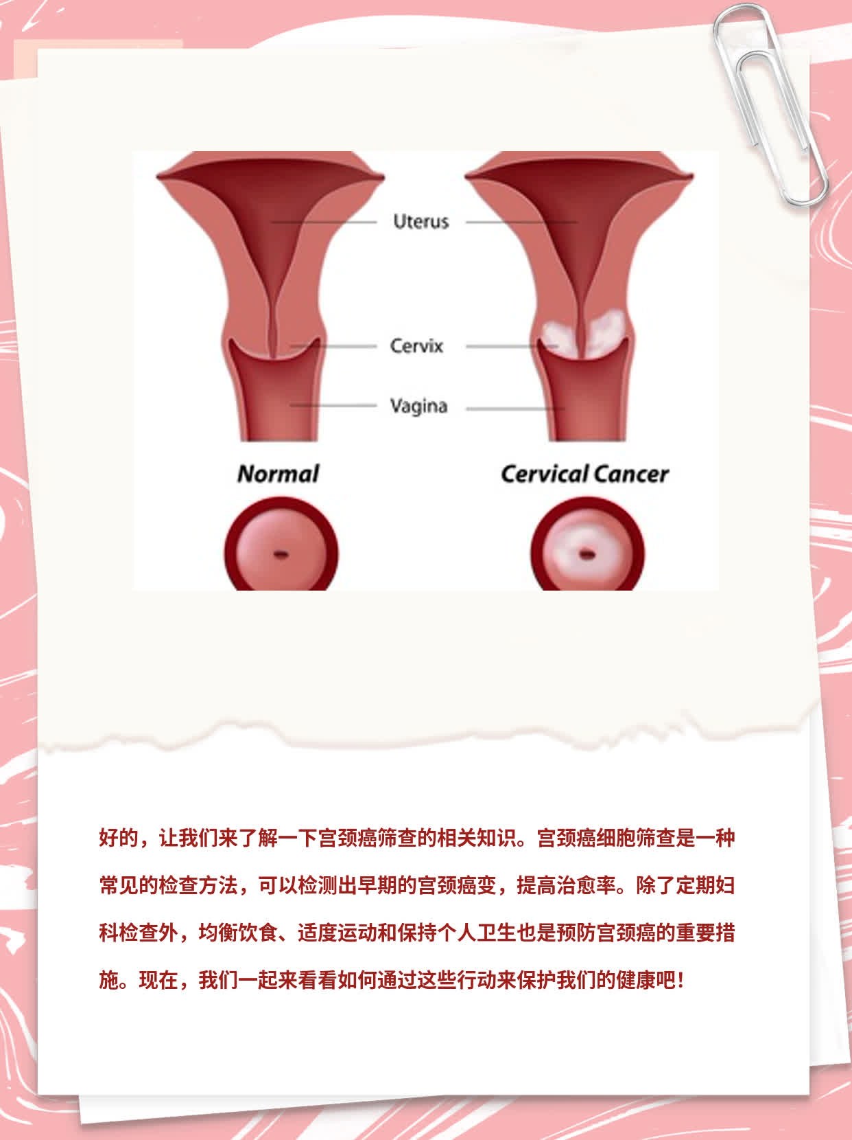 「宫颈癌筛查」——你不可不知的真相！