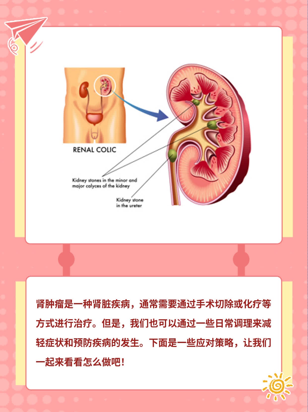 「肾肿瘤」：揭秘肾脏问题及应对策略！
