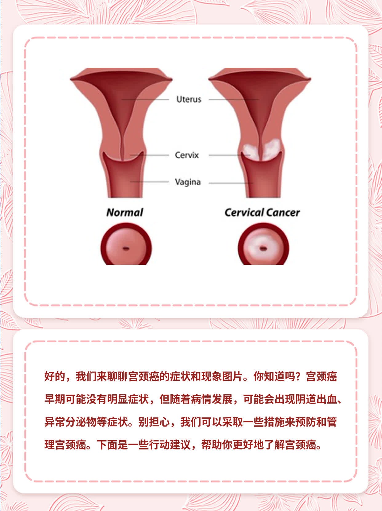 「宫颈癌症状图」认识它，不容忽视！