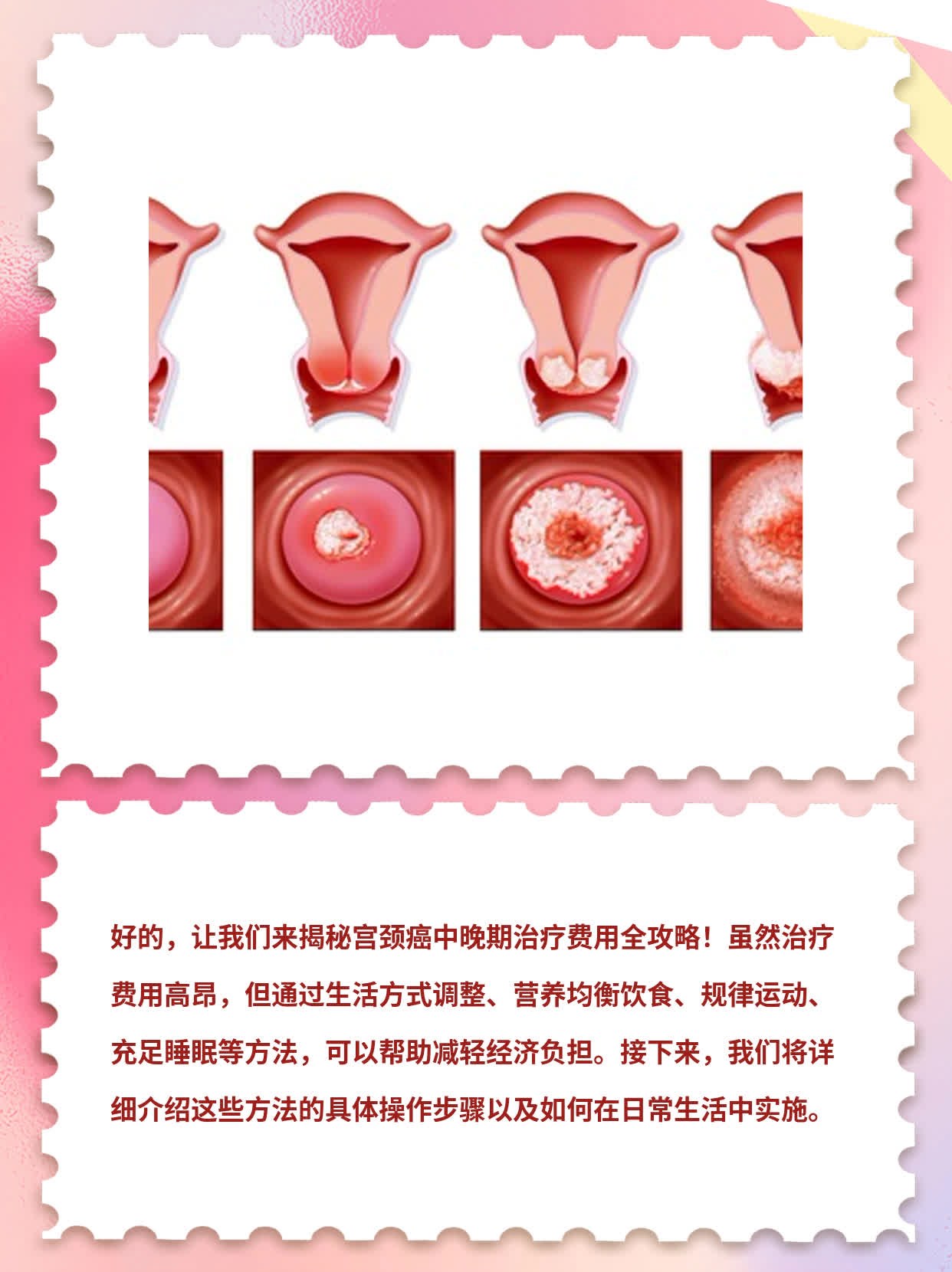 宫颈癌中晚期治疗费用全揭秘！