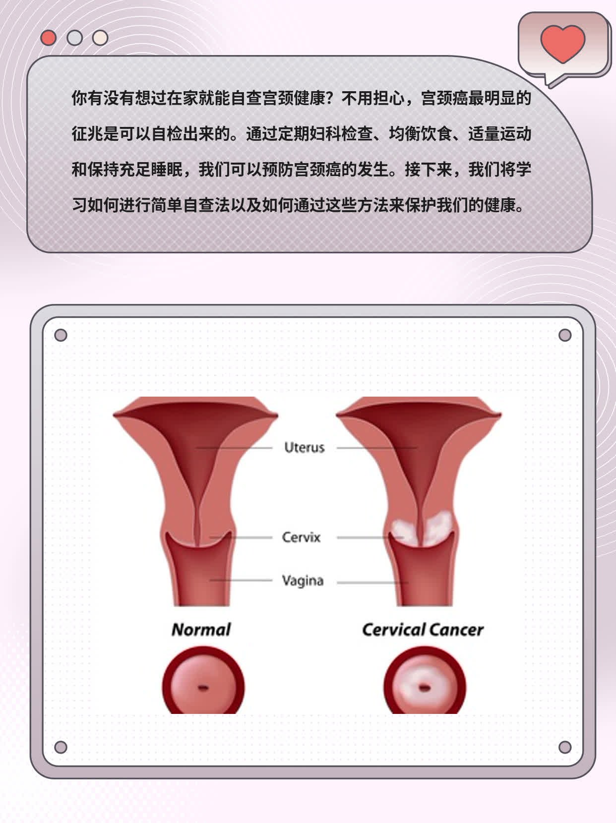 「自检」发现宫颈癌前兆！教你简单自查法