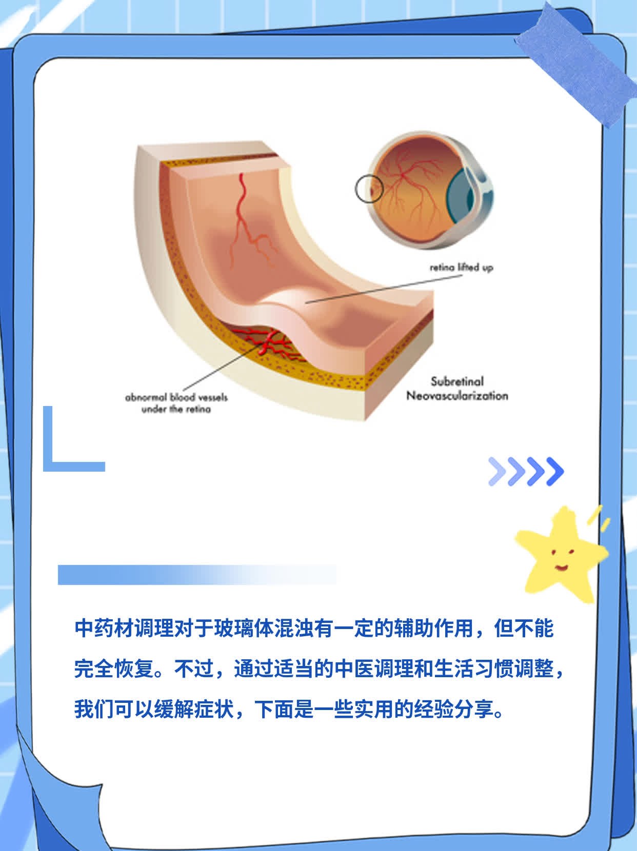 中药调理对玻璃体混浊有帮助吗？经验分享