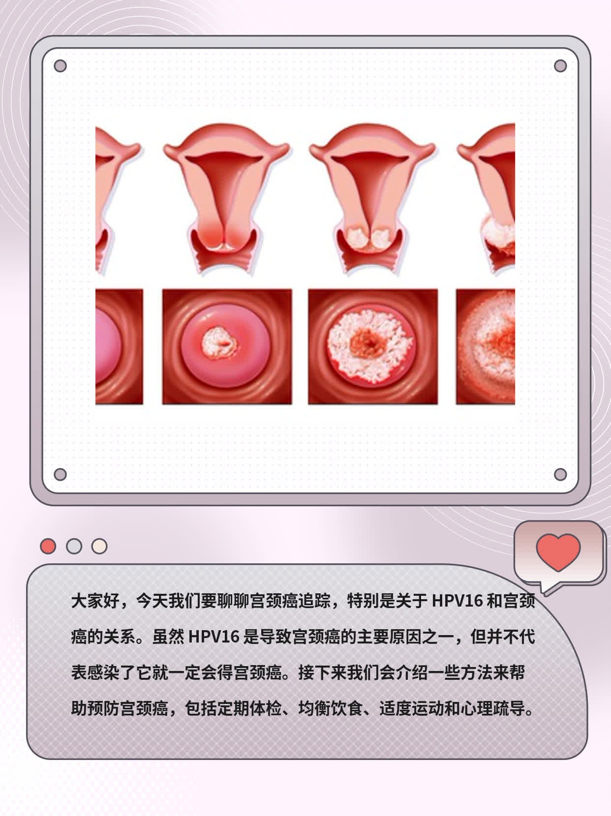 「宫颈癌」追踪：解开 HPV16 与宫颈癌的真相！