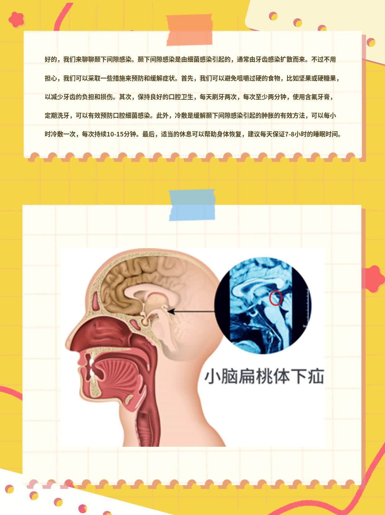 颞下间隙感染：揭秘病因！