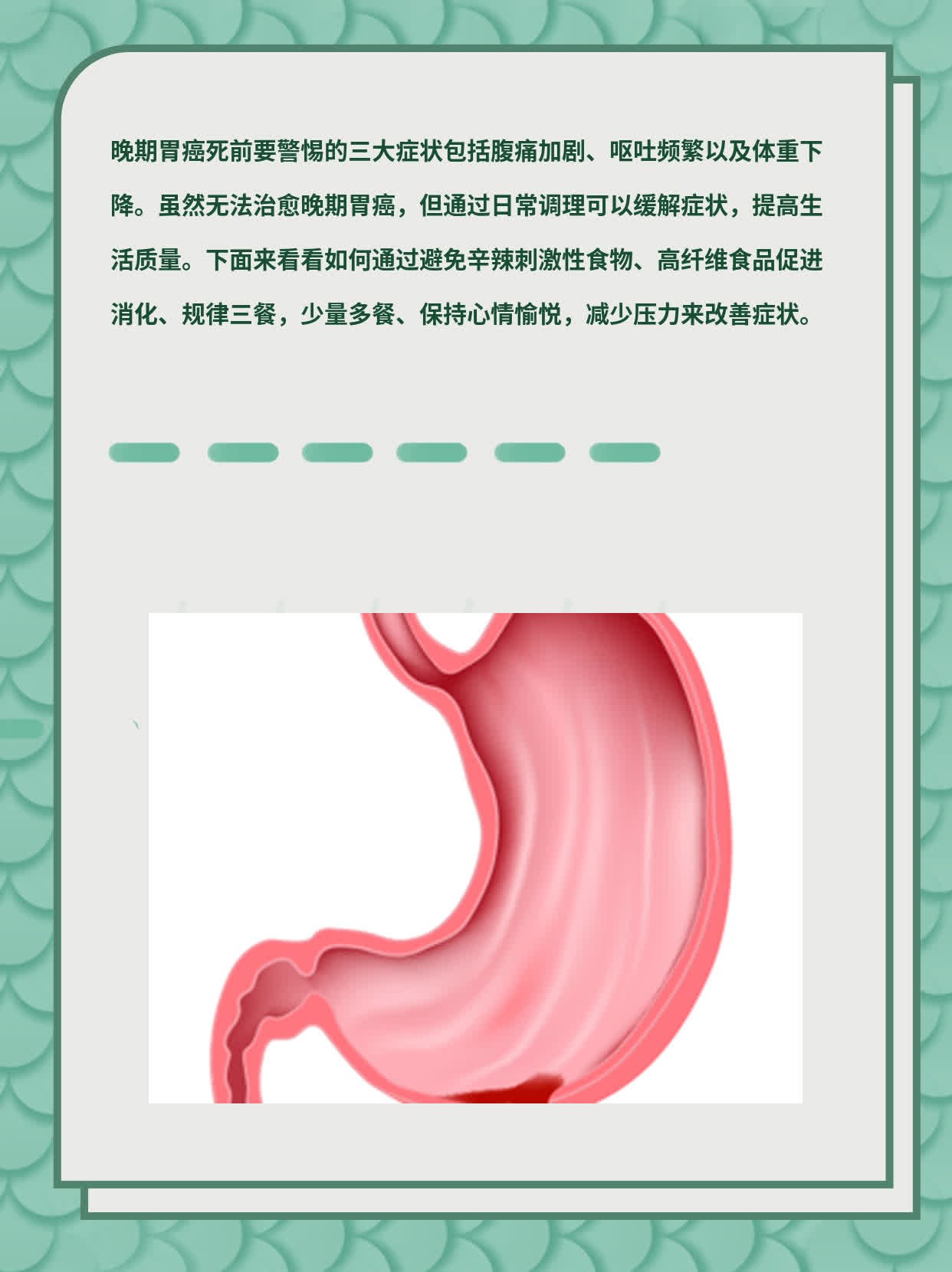 晚期胃癌临终征兆：三大信号不容忽视！