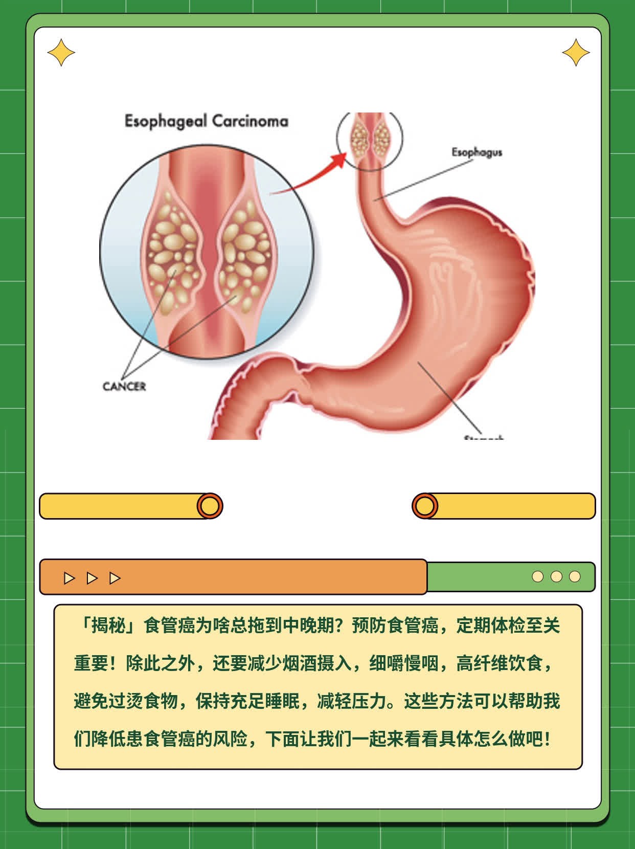 「揭秘」食管癌为啥总拖到中晚期？