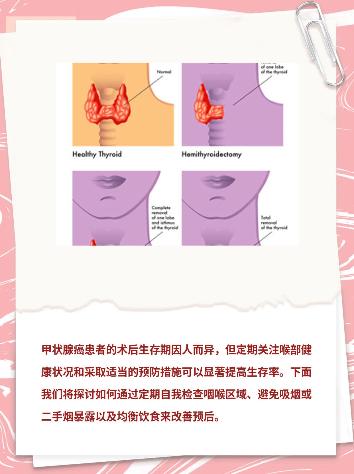 探究甲状腺癌术后生存期：一份患者的实战经验分享