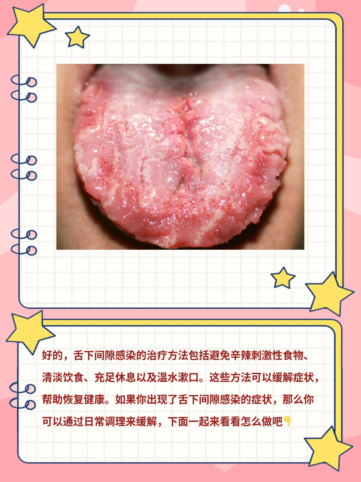 「舌下间隙感染」治疗妙招大公开！