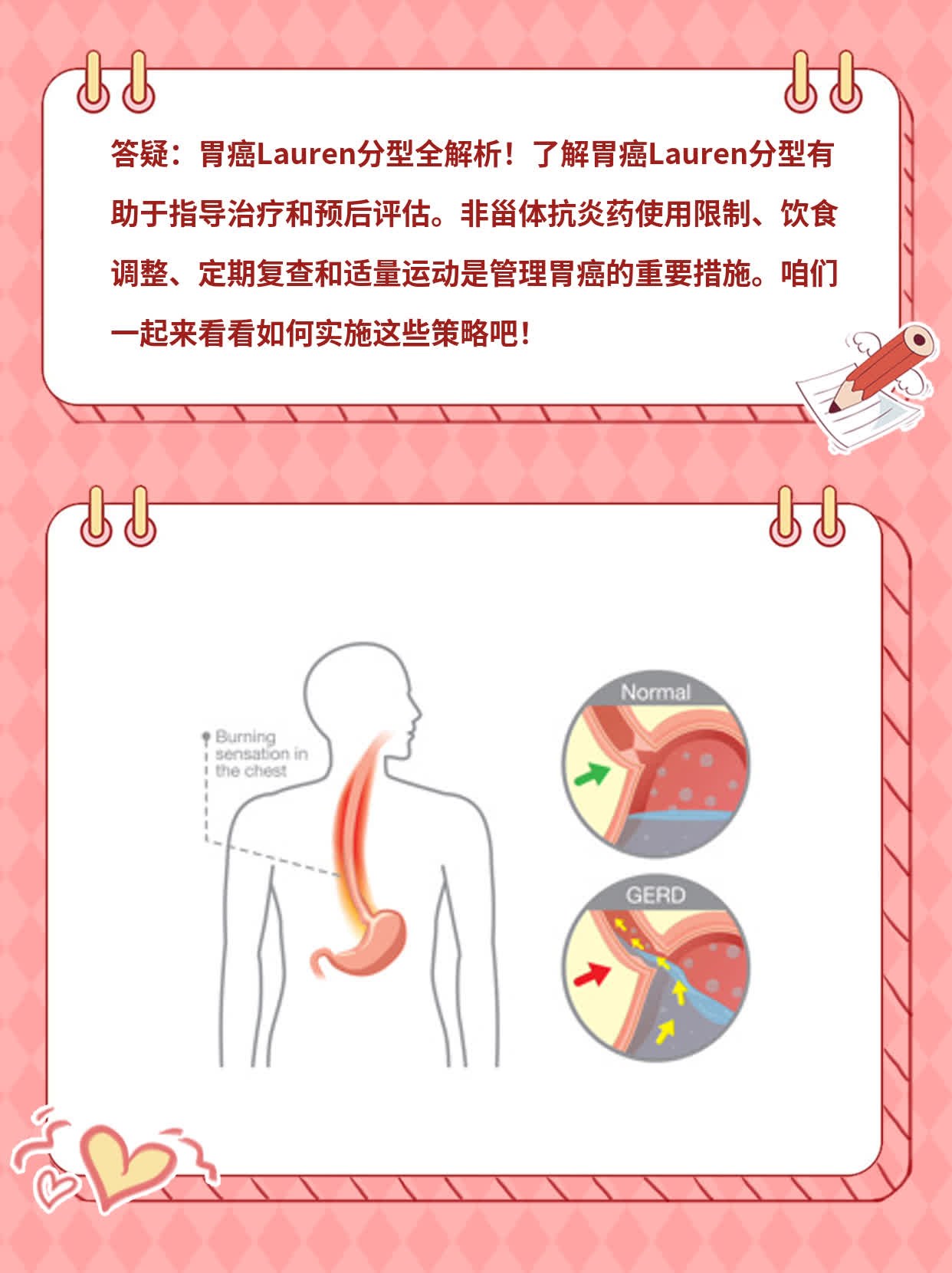 「答疑」揭秘：胃癌Lauren分型全解析