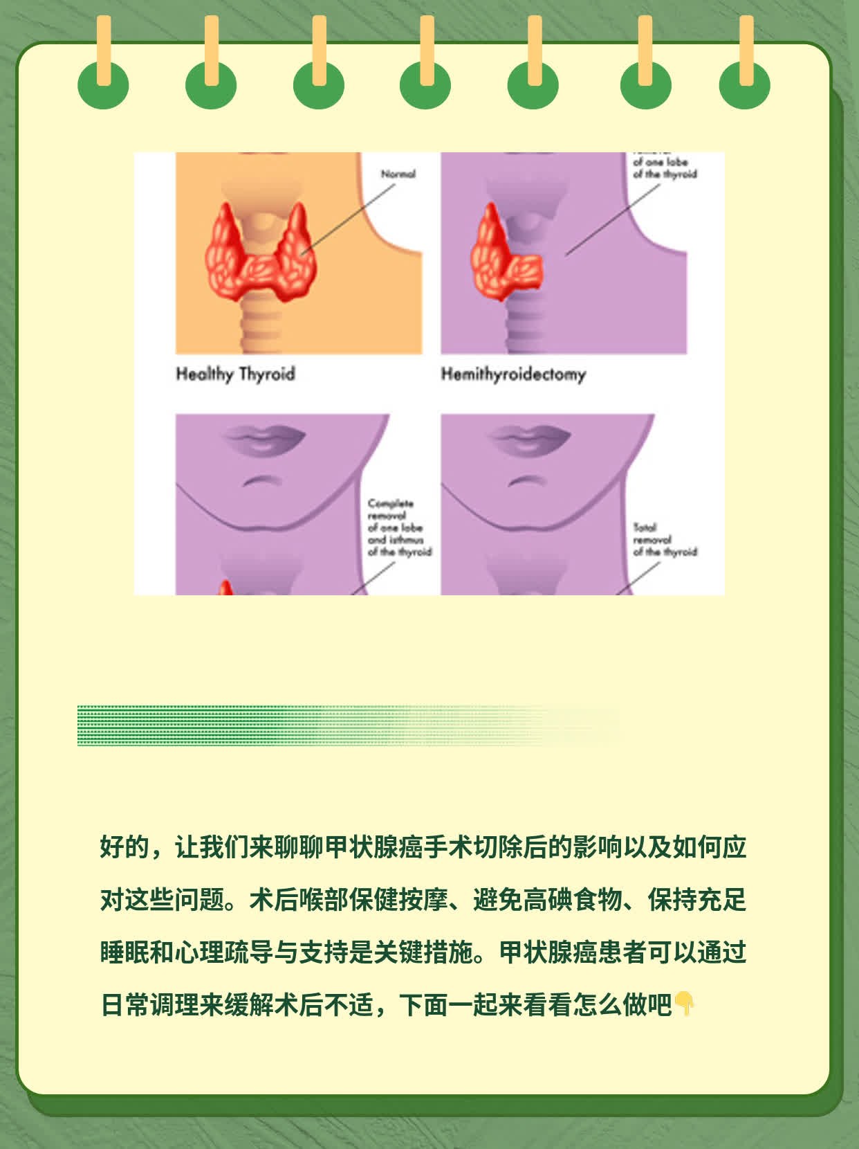 切掉甲状腺癌后的那些事儿：术后影响全解析！