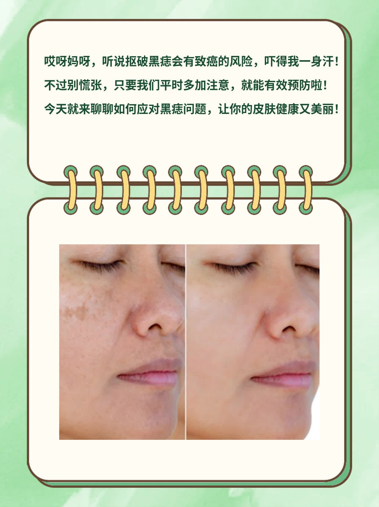 抠破黑痣会致癌？经验分享！