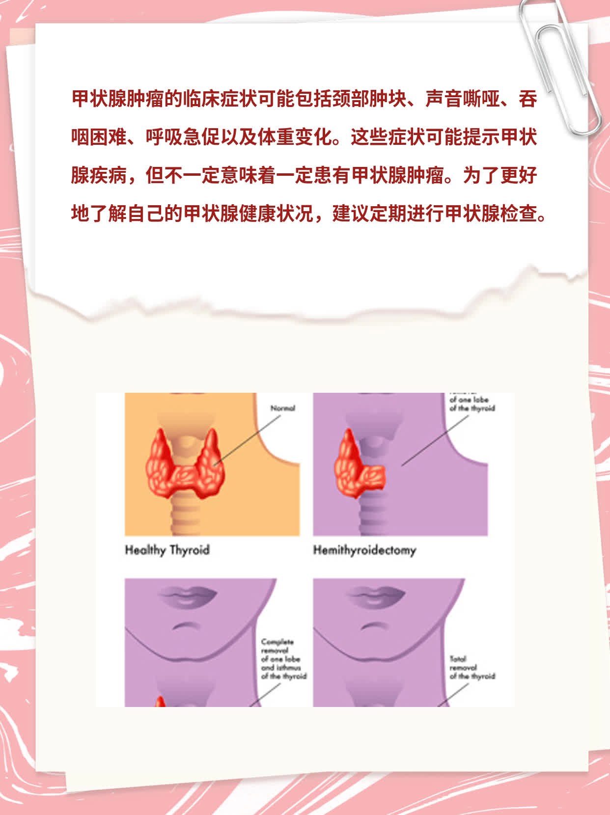 探秘甲状腺肿瘤：症状揭秘！