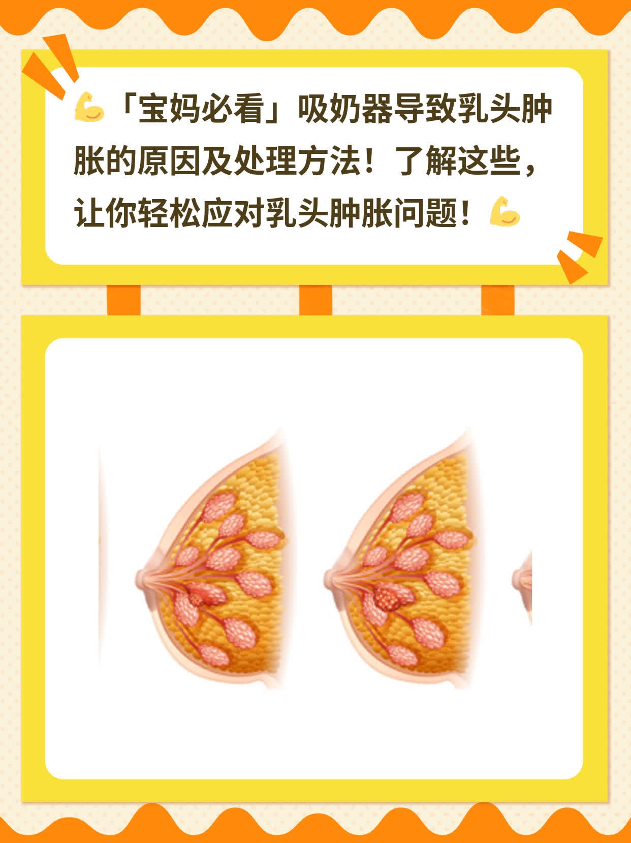 「宝妈必看」吸奶器导致乳头肿胀的原因及处理方法