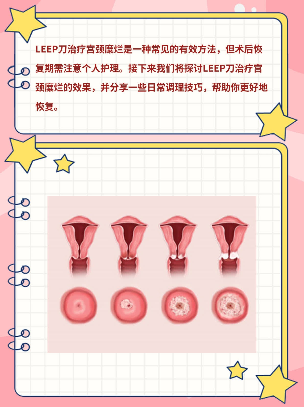 LEEP刀治宫颈糜烂效果如何？经验分享！