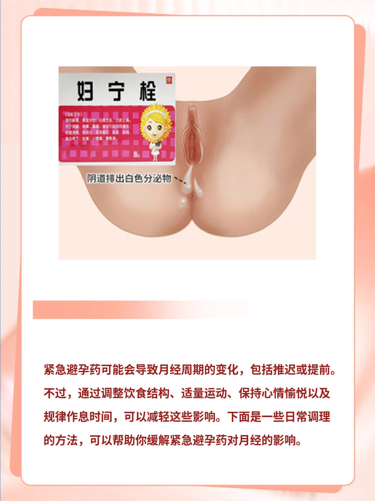 紧急避孕药对月经的影响：推迟？