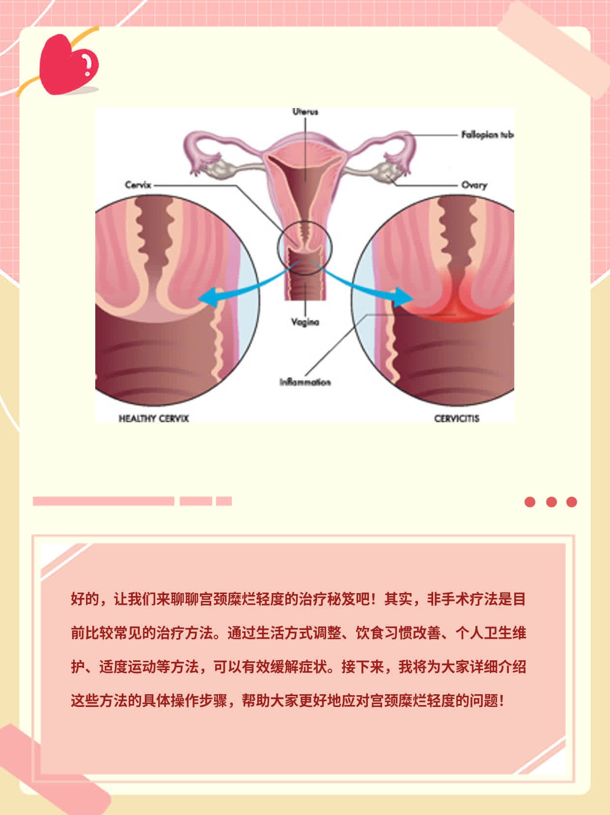 宫颈糜烂轻度治疗秘笈：非手术疗法！