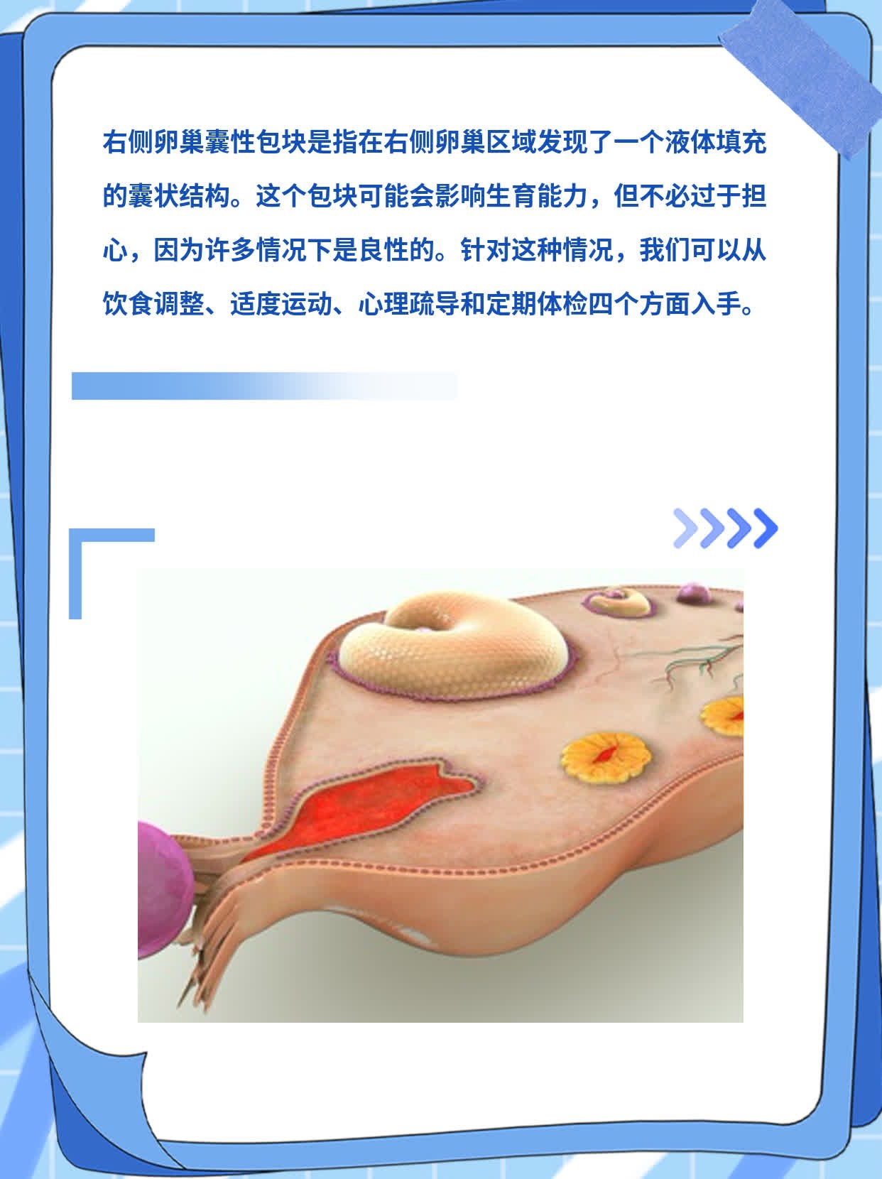 「右侧卵巢囊性包块」是怎么回事？