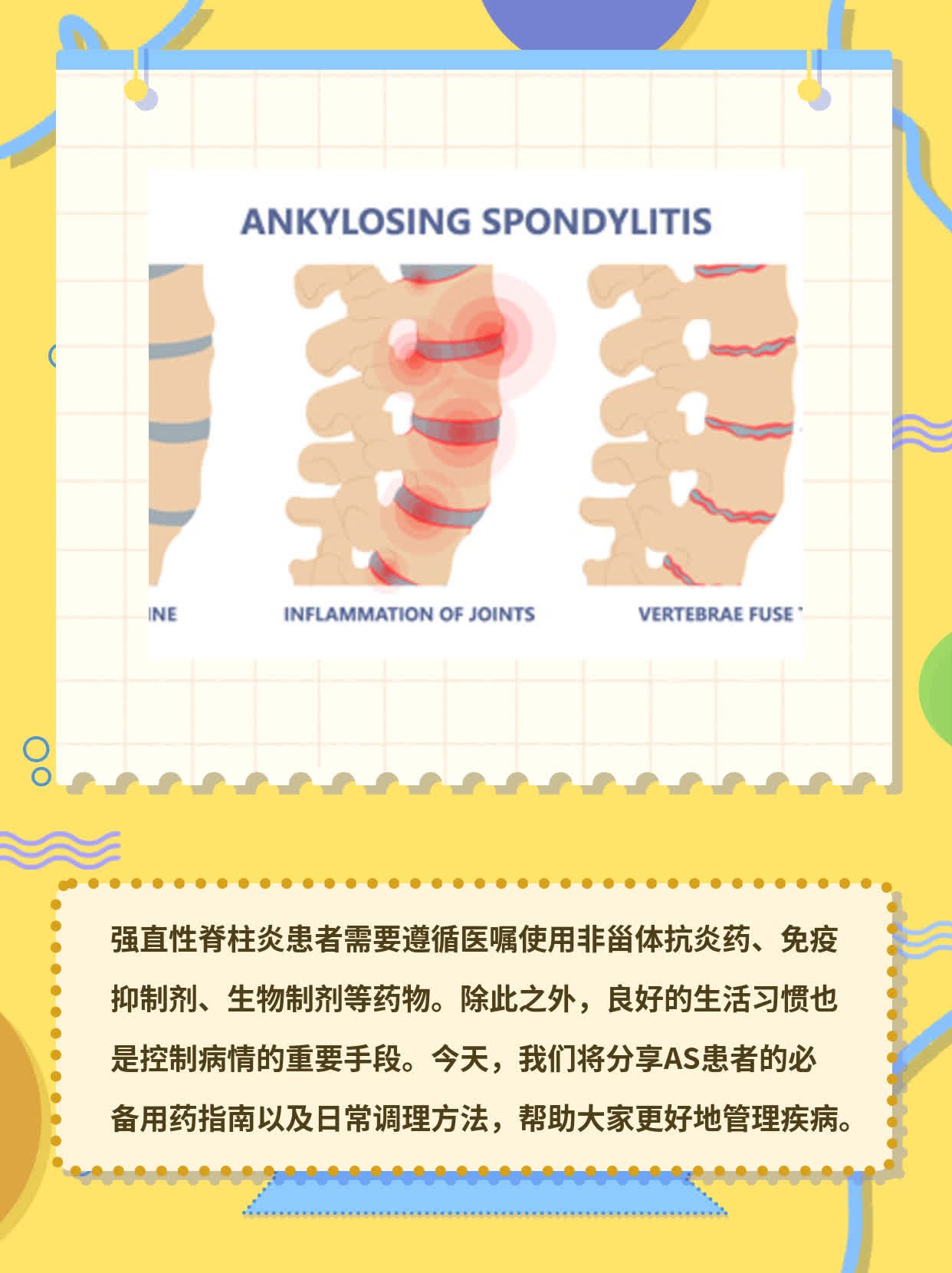 AS治疗必备：强直性脊柱炎用药指南