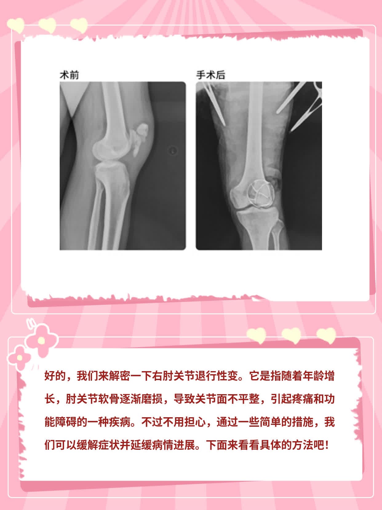 「解密」右肘关节退行性变的意思及处理方法