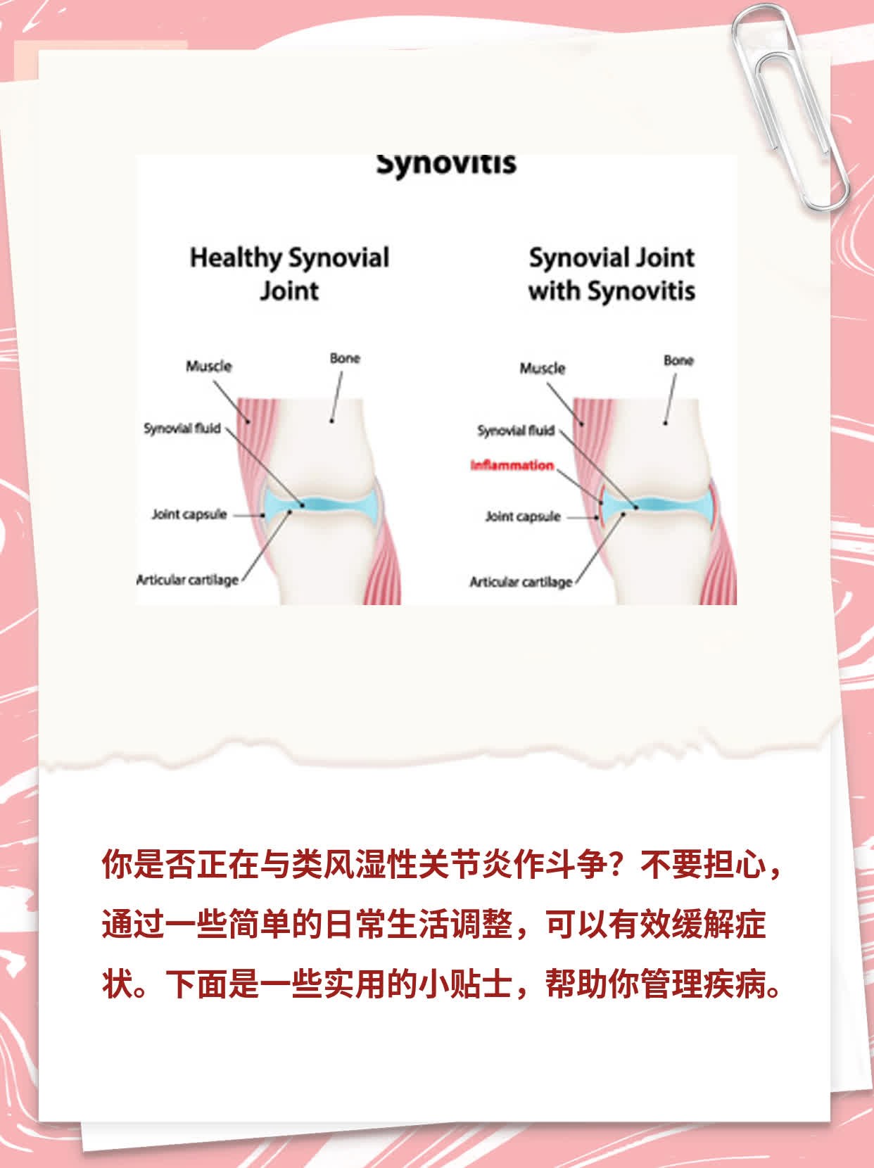 类风湿性关节炎：生活小贴士